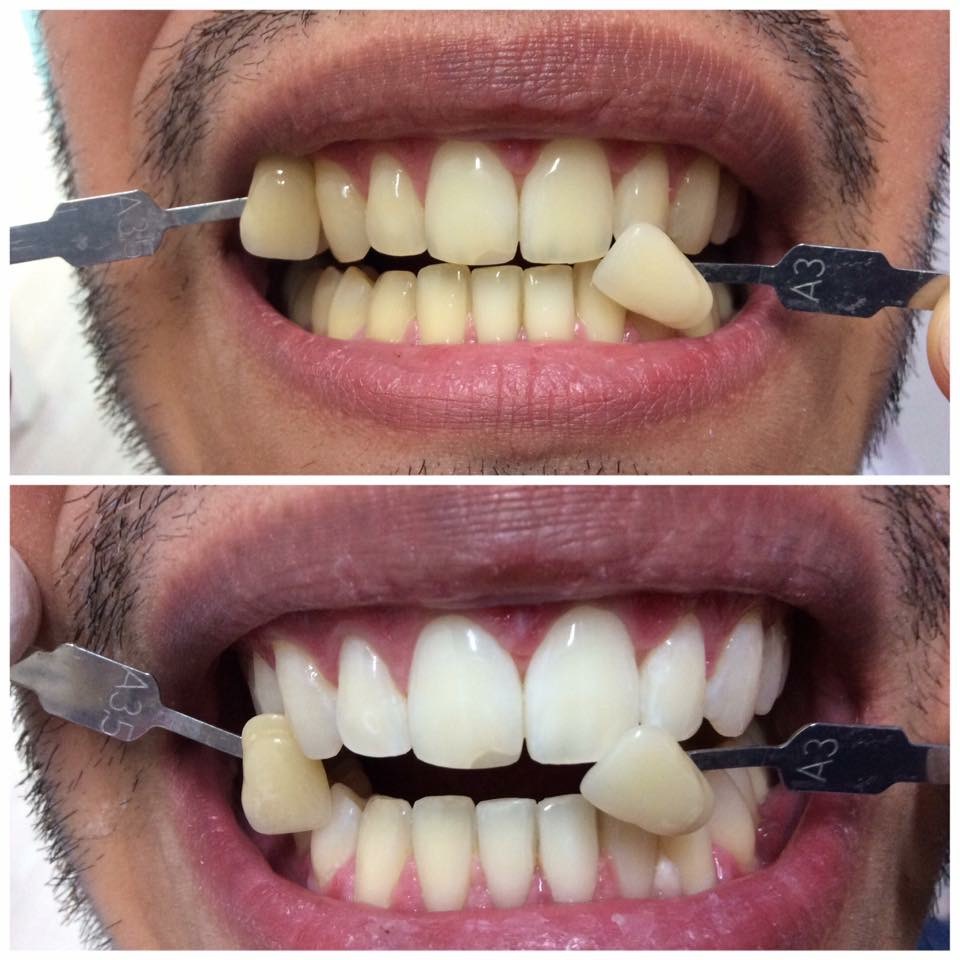 Estética Dental Clínica Denta Cote